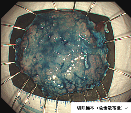大腸ESD症例
